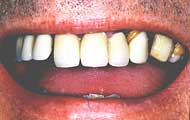 pretreatment a